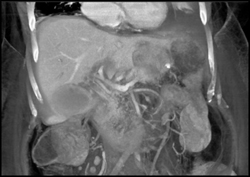 Multiple Liver Metastases - CTisus CT Scan