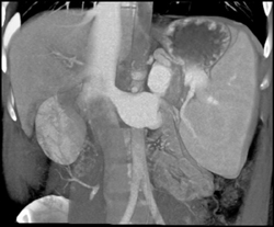 Huge Portal Vein - CTisus CT Scan