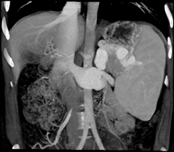 Splenorenal Shunting With Severe Portal Hypertension - CTisus CT Scan