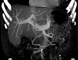 S/P Liver Transplant With Mild Stricture at the Portal Vein (PV) Anastomosis - CTisus CT Scan