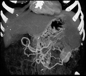 Portal Hypertension With Collaterals - CTisus CT Scan