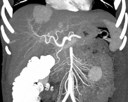 Focal Nodular Hyperplasia (FNH) - CTisus CT Scan