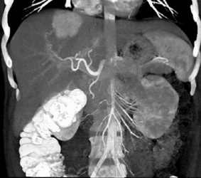 Focal Nodular Hyperplasia (FNH) - CTisus CT Scan