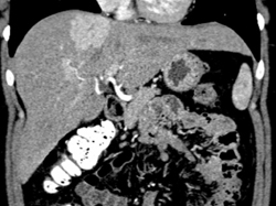 Focal Nodular Hyperplasia (FNH) - CTisus CT Scan