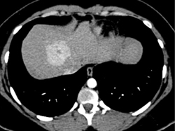 Focal Nodular Hyperplasia (FNH) - CTisus CT Scan