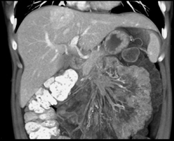 Focal Nodular Hyperplasia (FNH) - CTisus CT Scan