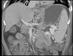 Cirrhosis With Partial Portal Vein Thrombosis (PVT) and Varices - CTisus CT Scan