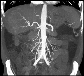 Cirrhosis With Abnormal Enhancement of the Liver on Arterial Phase - CTisus CT Scan