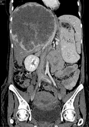 Hepatoma - CTisus CT Scan