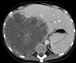 Hepatoma - CTisus CT Scan