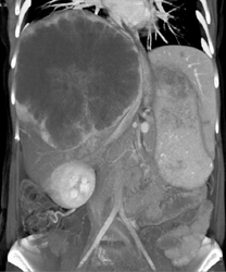 Hepatoma - CTisus CT Scan