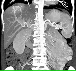 Arteriovenous Malformation (AVM) Liver - CTisus CT Scan