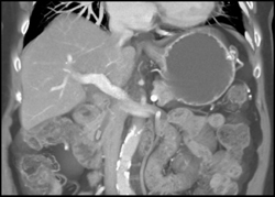 Clip in Distal Common Bile Duct (CBD) - CTisus CT Scan