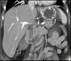 Thickened Distal Common Bile Duct (CBD) - CTisus CT Scan