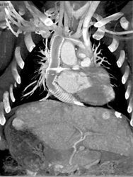 Conduit to Subclavian Vein and IVC - CTisus CT Scan