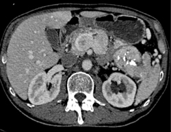 Liver Metastases From Islet Cell Tumor With Portal Vein Invasion - CTisus CT Scan