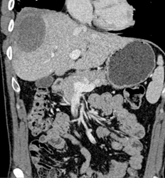 Liver Abscess - CTisus CT Scan