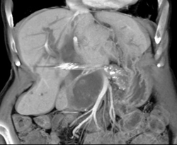 Cystic Tumor Obstructs the Common Duct - CTisus CT Scan