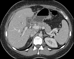 Cholangiocarcinoma - CTisus CT Scan