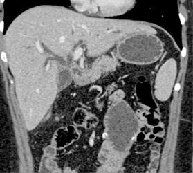 Cholangiocarcinoma - CTisus CT Scan