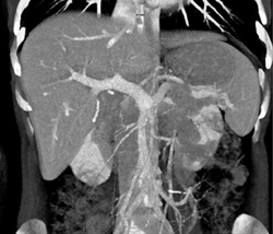 Cholangiocarcinoma - CTisus CT Scan