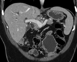 Cholangiocarcinoma - CTisus CT Scan