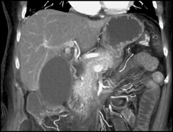 Acute Cholecystitis - CTisus CT Scan