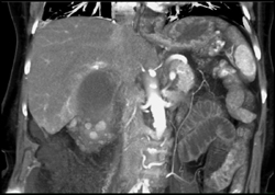 Acute Cholecystitis - CTisus CT Scan