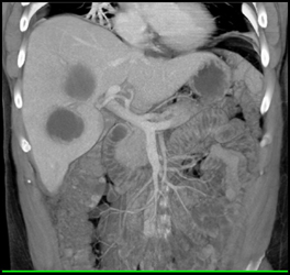 Liver Abscess - CTisus CT Scan