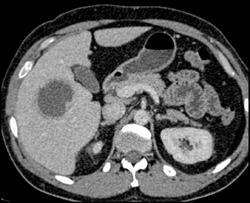 Liver Abscess - CTisus CT Scan