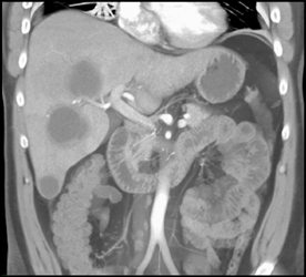 Liver Abscess - CTisus CT Scan