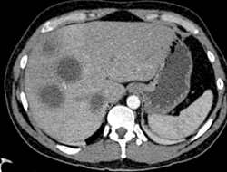 Liver Abscess - CTisus CT Scan