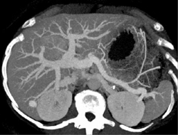 Focal Nodular Hyperplasia (FNH) - CTisus CT Scan