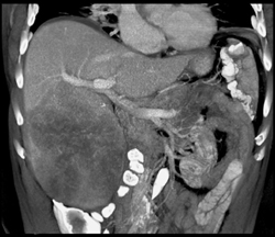 Hepatoma - CTisus CT Scan