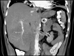 Hepatoma - CTisus CT Scan