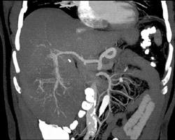 Hepatoma - CTisus CT Scan