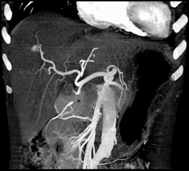 Av-fistulae - CTisus CT Scan