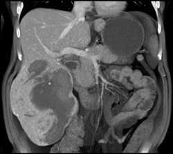 Intrahepatic Bleed Within A Mass - CTisus CT Scan