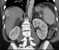 Hepatoma - CTisus CT Scan