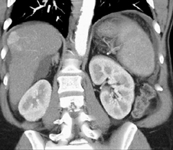 Hepatoma - CTisus CT Scan