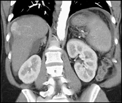 Hepatoma - CTisus CT Scan