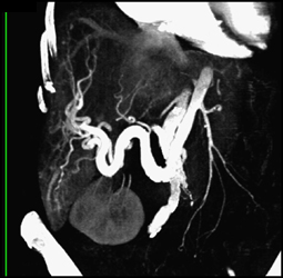 Enlarged Right Hepatic Artery - CTisus CT Scan