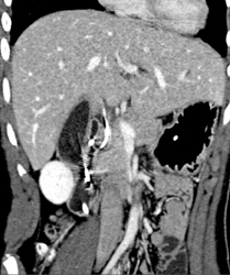 Stone in Common Bile Duct (CBD) - CTisus CT Scan