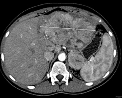 Hepatoma - CTisus CT Scan