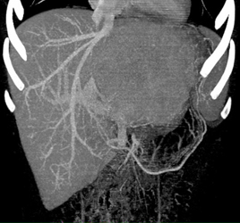 Hepatoma - CTisus CT Scan