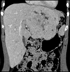 Hepatoma - CTisus CT Scan