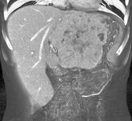 Hepatoma - CTisus CT Scan