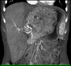 Hepatoma - CTisus CT Scan