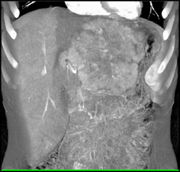 Hepatoma - CTisus CT Scan