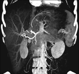 Hepatoma - CTisus CT Scan